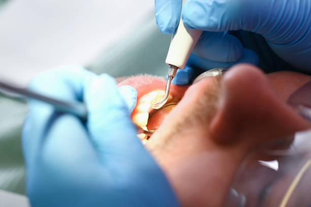 Best Emergency Dentist for Lost Fillings or Crowns in Tybee Island, GA